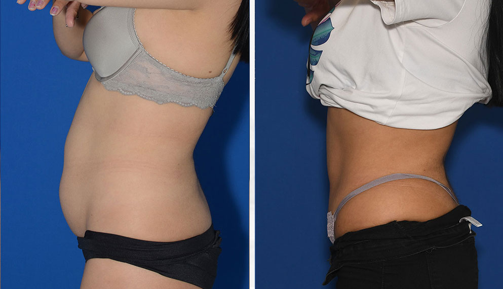Before and After Liposuction
