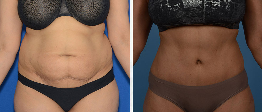 Before and After Tummy Tuck
