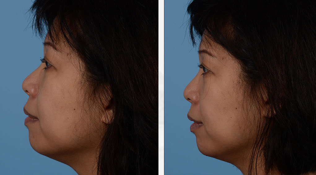 Chin Augmentation Before & After