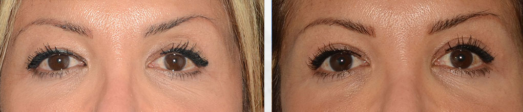 Before and After Blepharoplasty