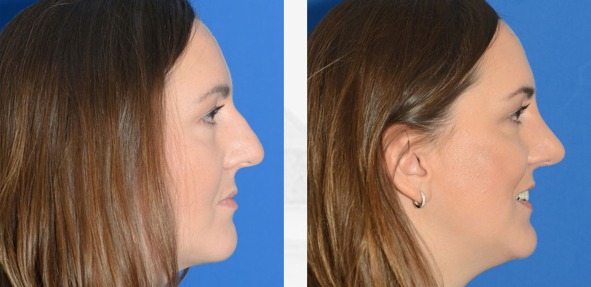 Rhinoplasty Before & After