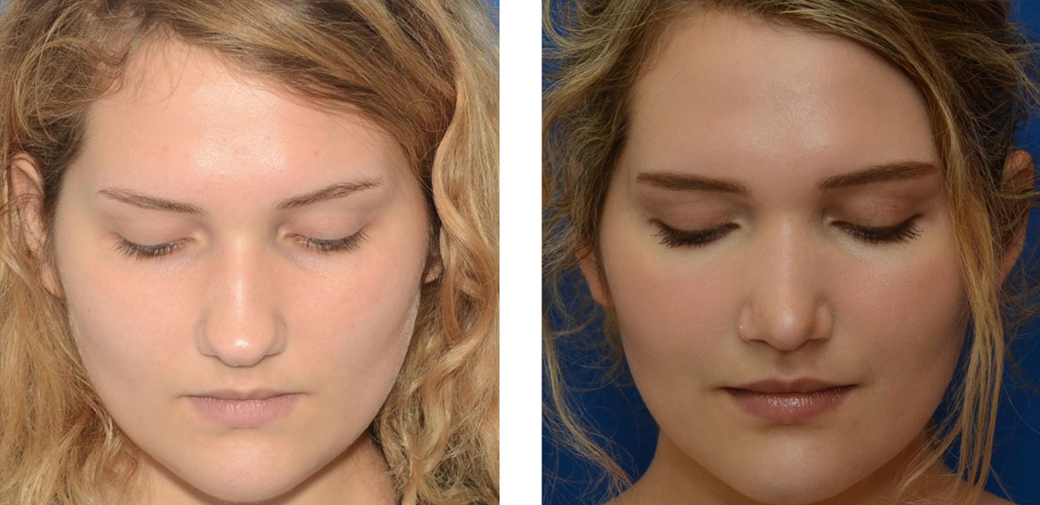 Before and After Nose Job