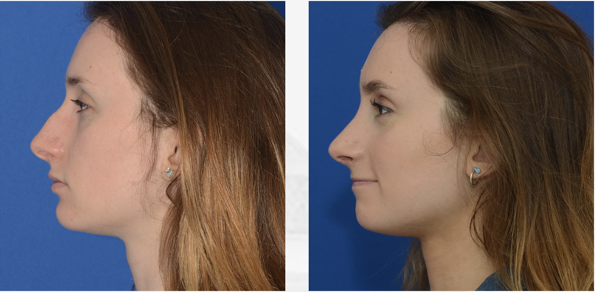 Rhinoplasty Surgery Results