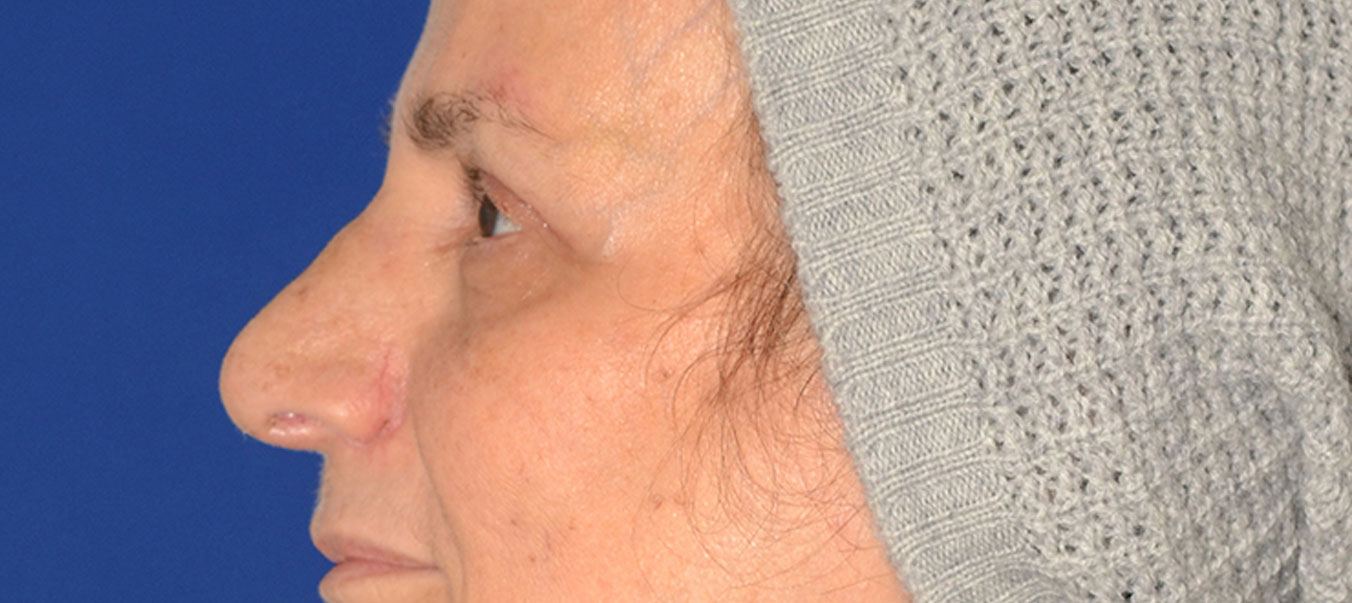 Blepharoplasty Before & After Photo #4