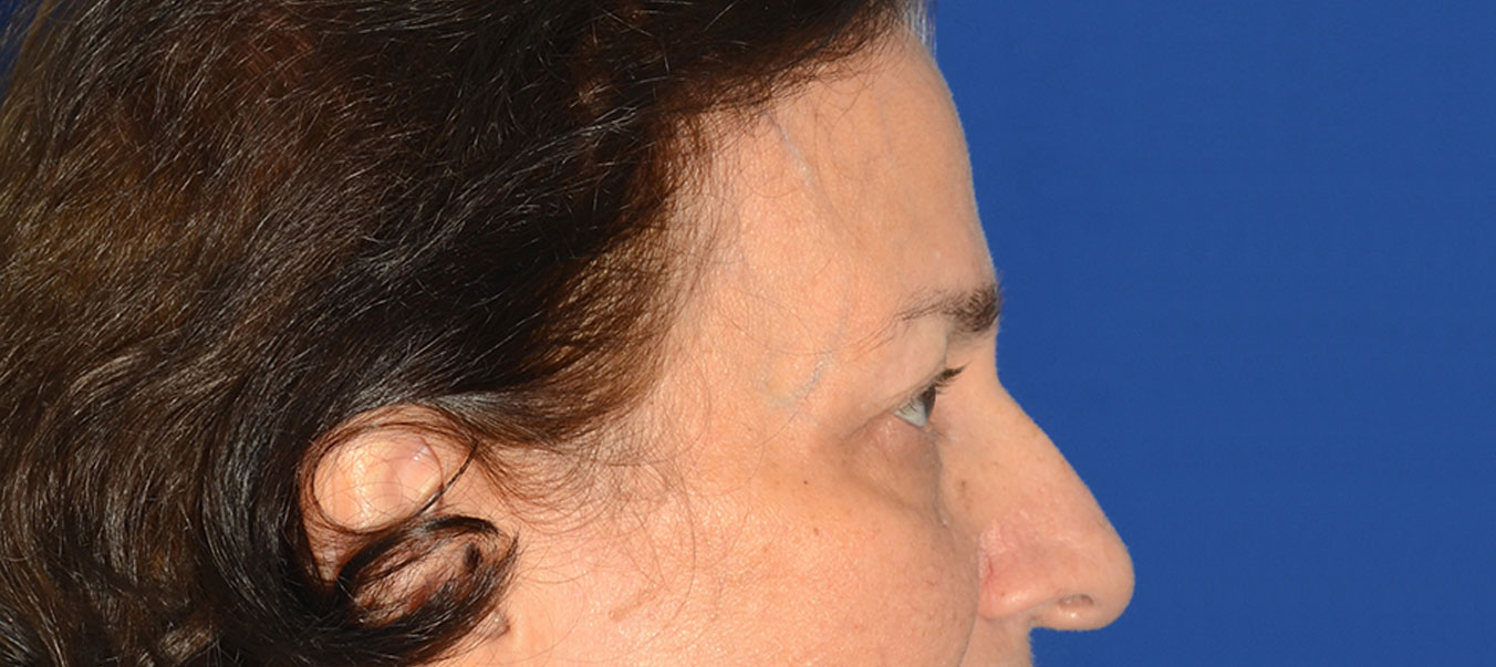 Blepharoplasty Before & After Photo #7