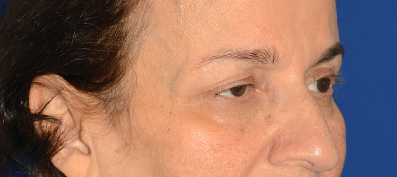 Blepharoplasty Before & After Photo #9