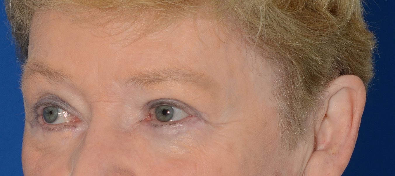 Blepharoplasty Before & After Photo #4