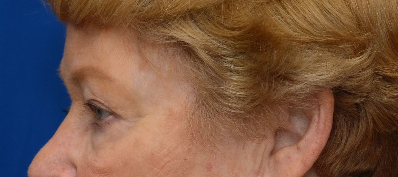 Blepharoplasty Before & After Photo #5