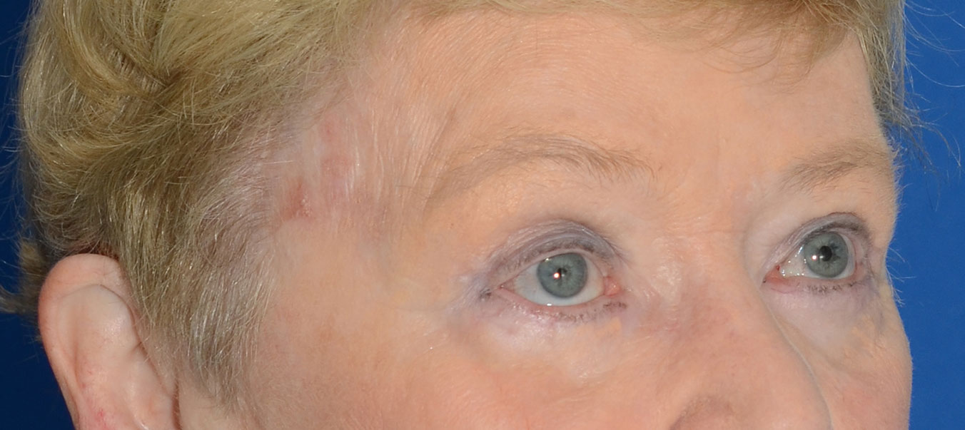 Blepharoplasty Before & After Photo #8