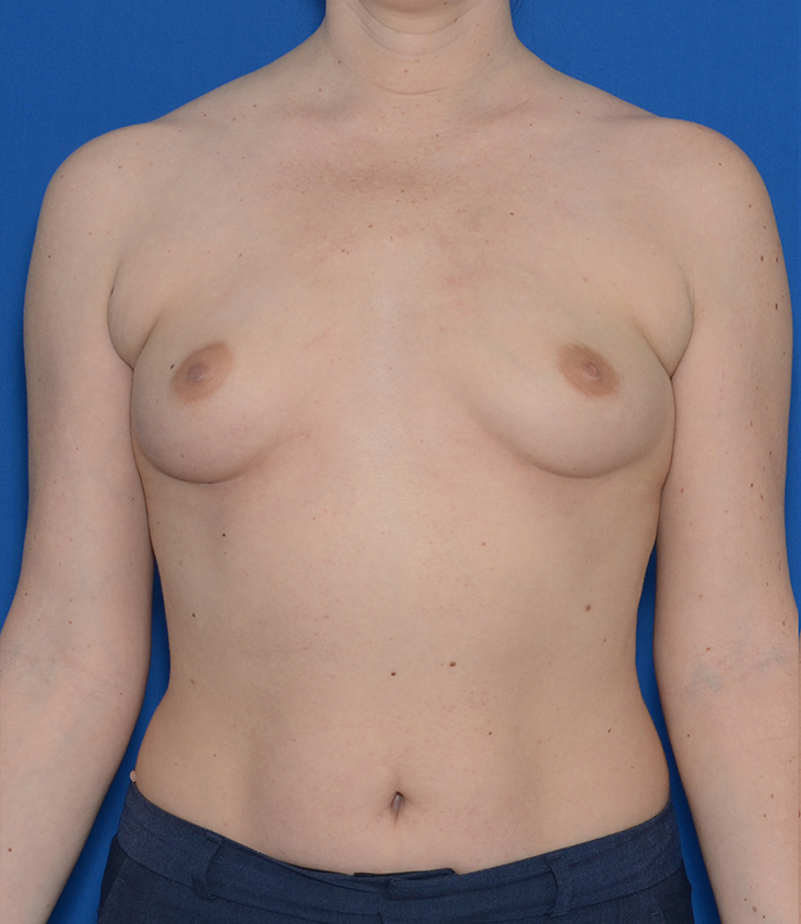 Breast Augmentation Before & After Photo #1