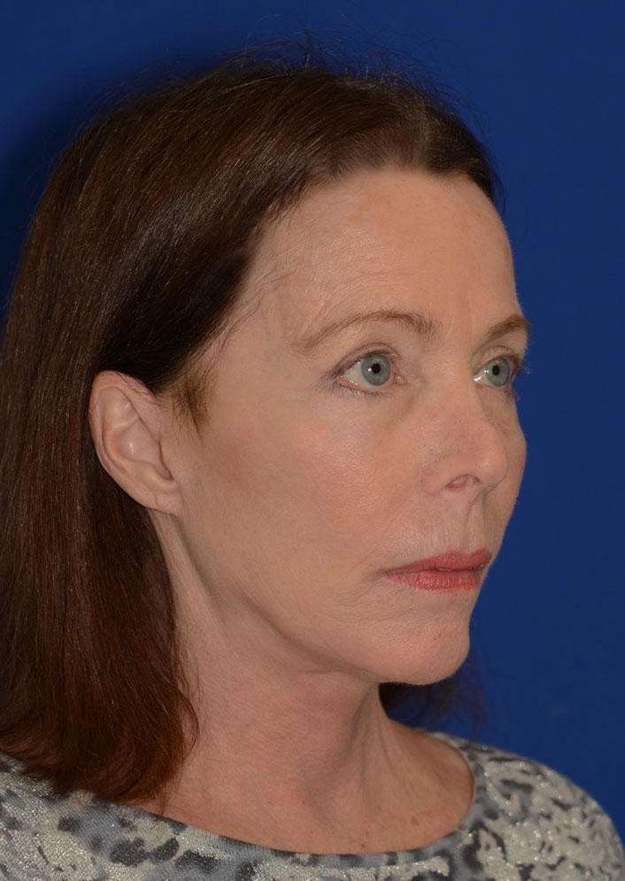Facelift Before & After Photo #4