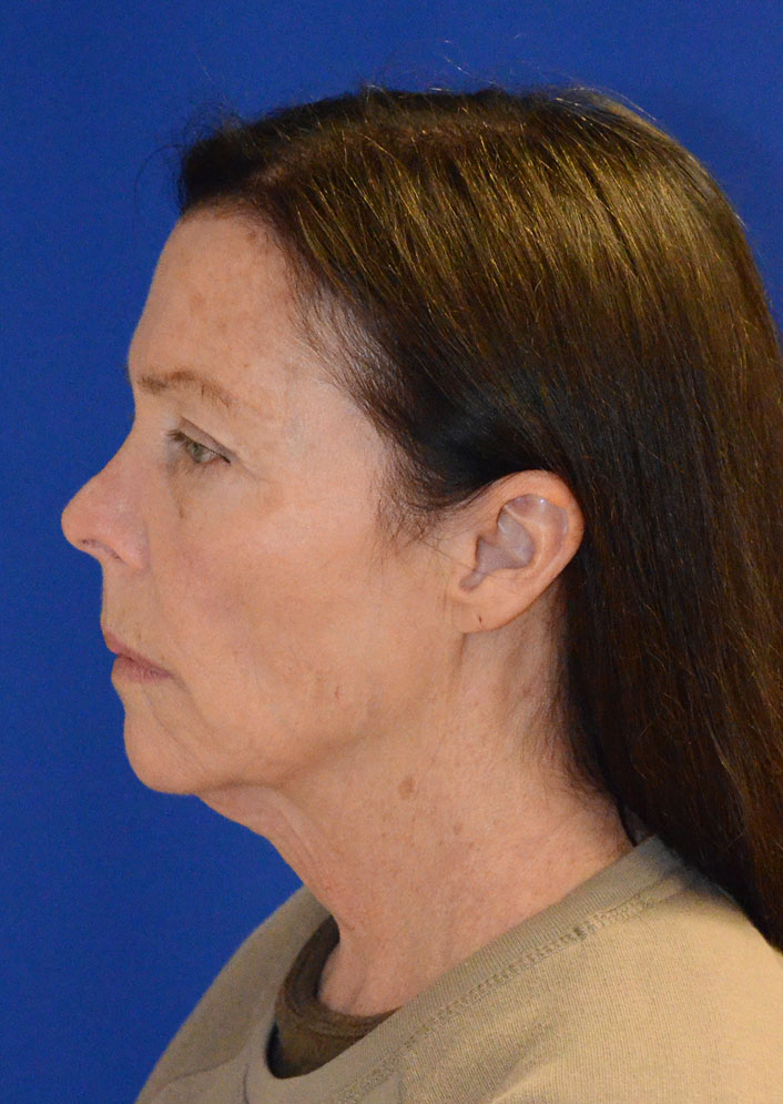 Facelift Before & After Photo #5