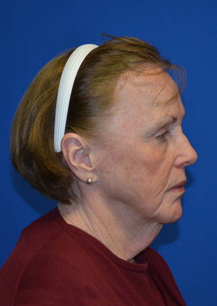 Facelift Before & After Photo #7