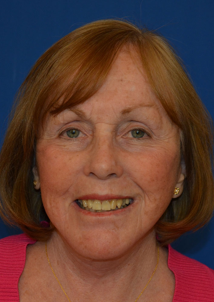 Facelift Before & After Photo #10