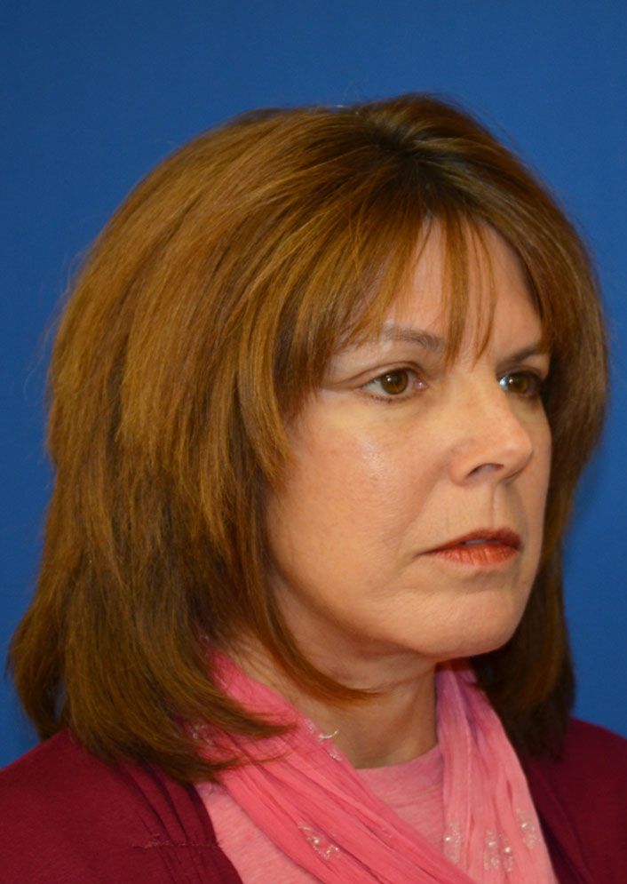 Facelift Before & After Photo #4