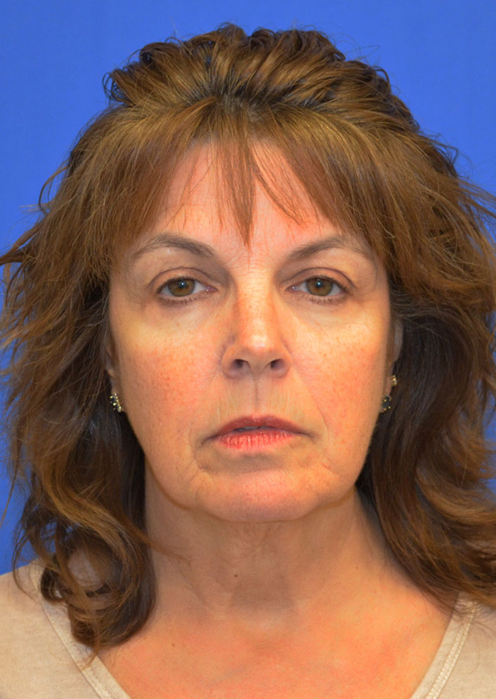 Facelift Before & After Photo #9