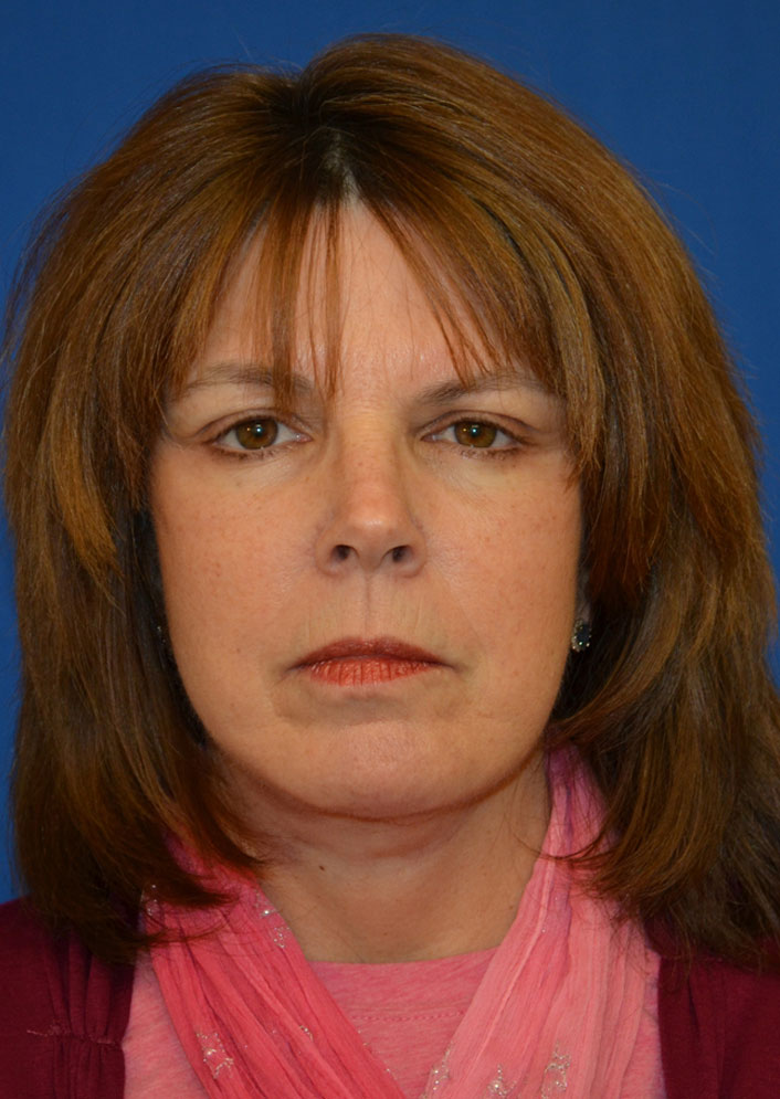 Facelift Before & After Photo #10