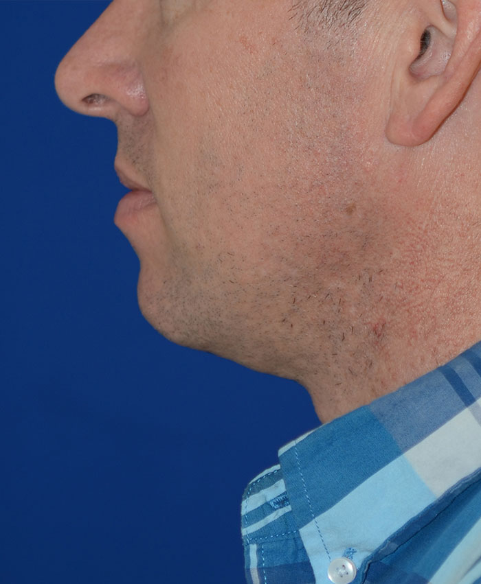 Liposuction Before & After Photo #4