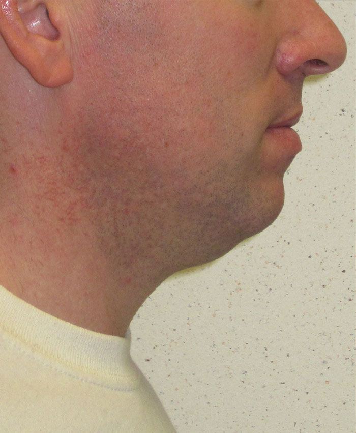 Liposuction Before & After Photo #5