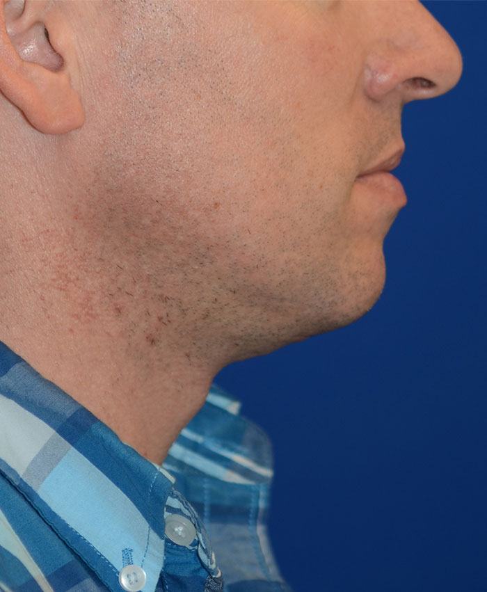 Liposuction Before & After Photo #6