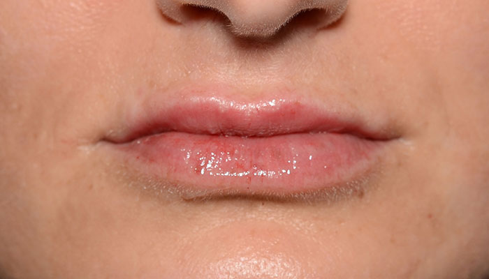 Lips Before & After Photo #2