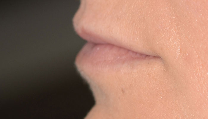Lips Before & After Photo #3