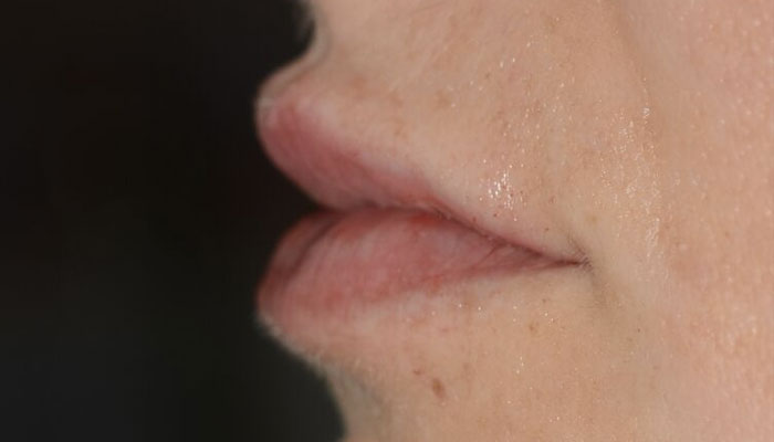 Lips Before & After Photo #4