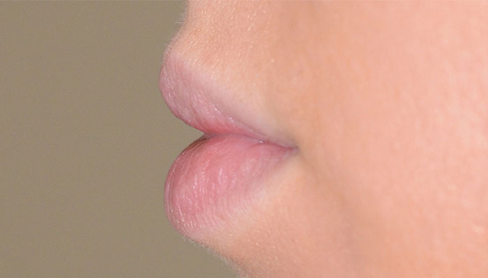 Lips Before & After Photo #3