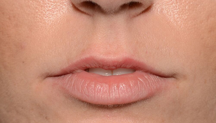 Lips Before & After Photo #1