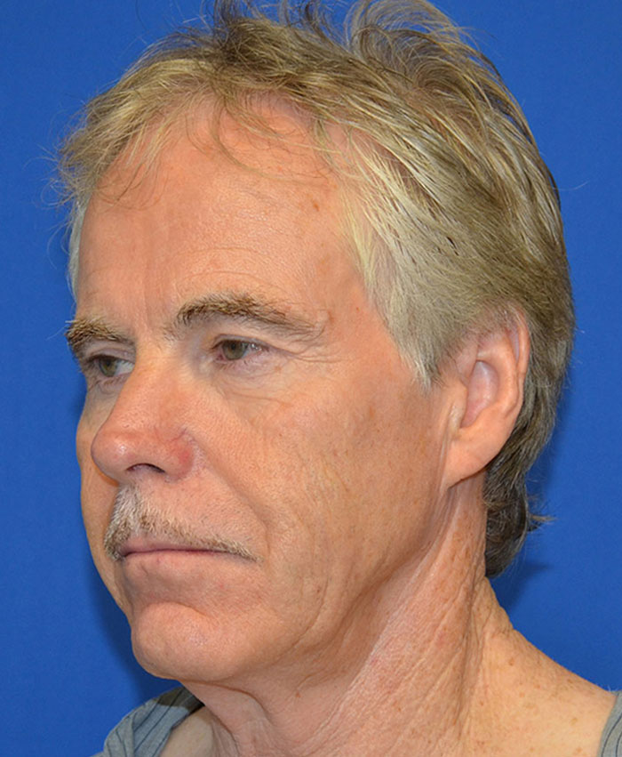 Male Plastic Surgery Before & After Photo #1