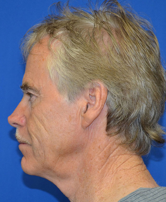 Male Plastic Surgery Before & After Photo #5