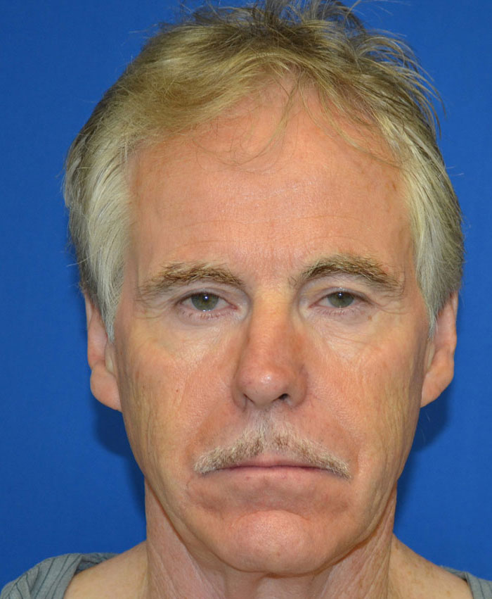 Male Plastic Surgery Before & After Photo #9