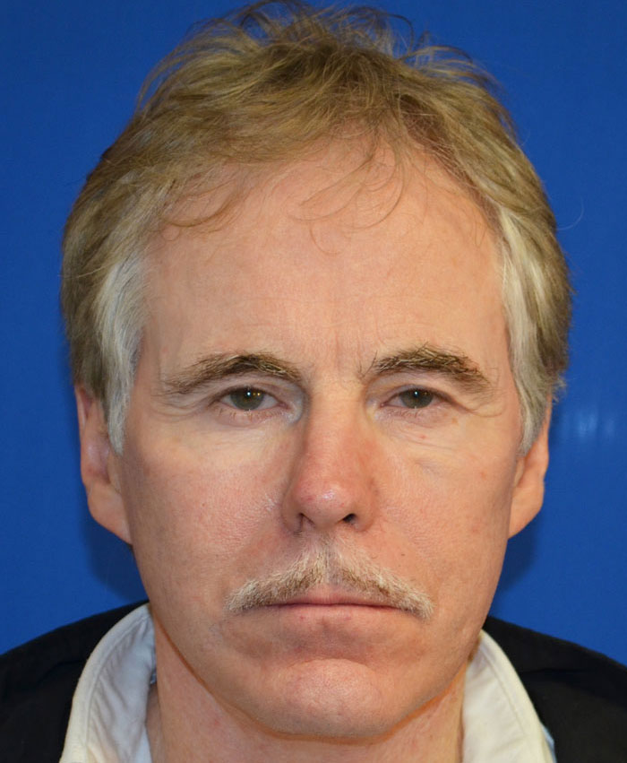 Male Plastic Surgery Before & After Photo #10