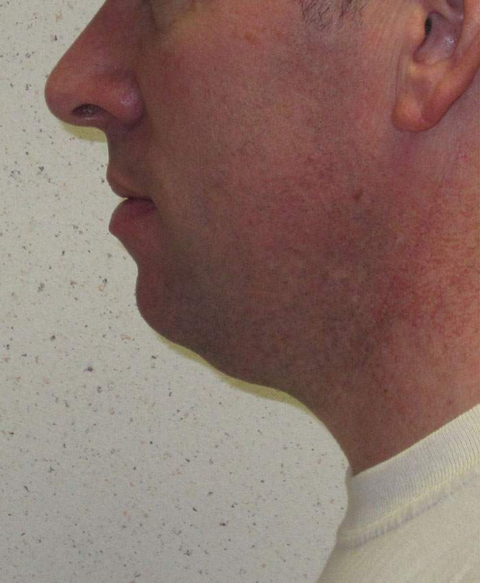 Male Plastic Surgery Before & After Photo #3