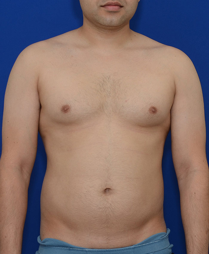 Male Plastic Surgery Before & After Photo #1