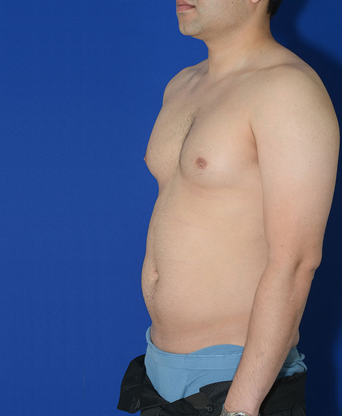 Male Plastic Surgery Before & After Photo #5
