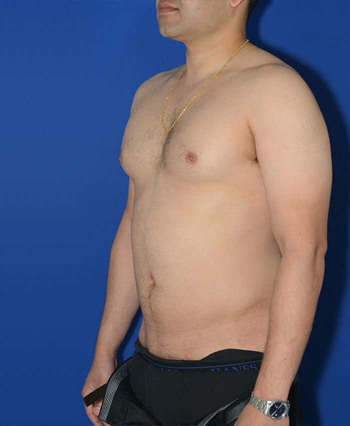 Male Plastic Surgery Before & After Photo #6