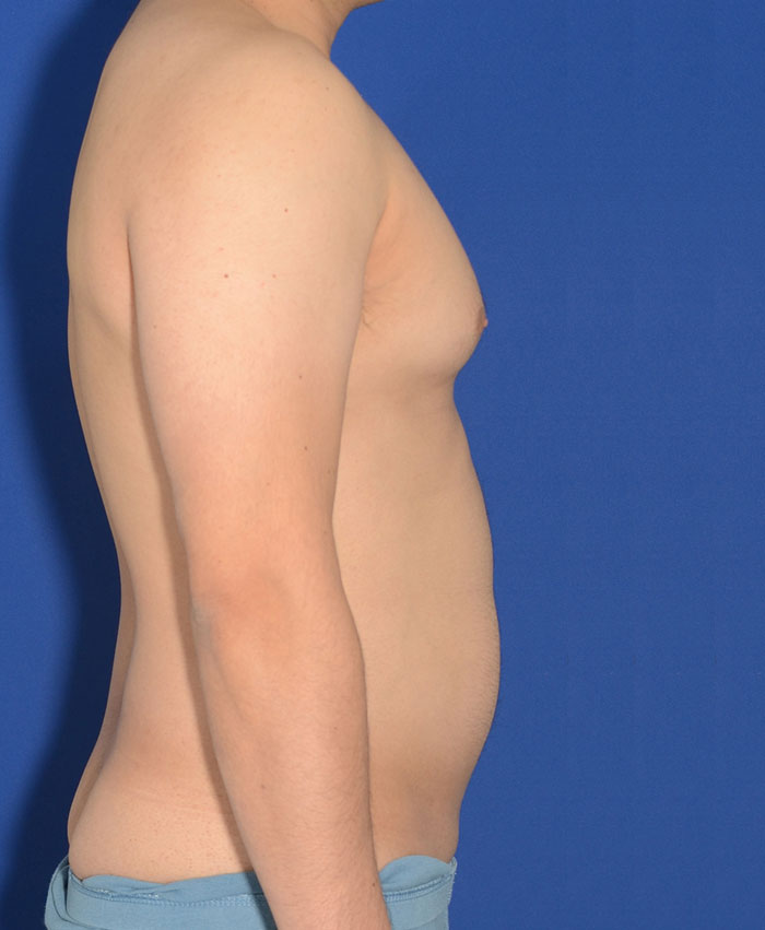 Male Plastic Surgery Before & After Photo #7