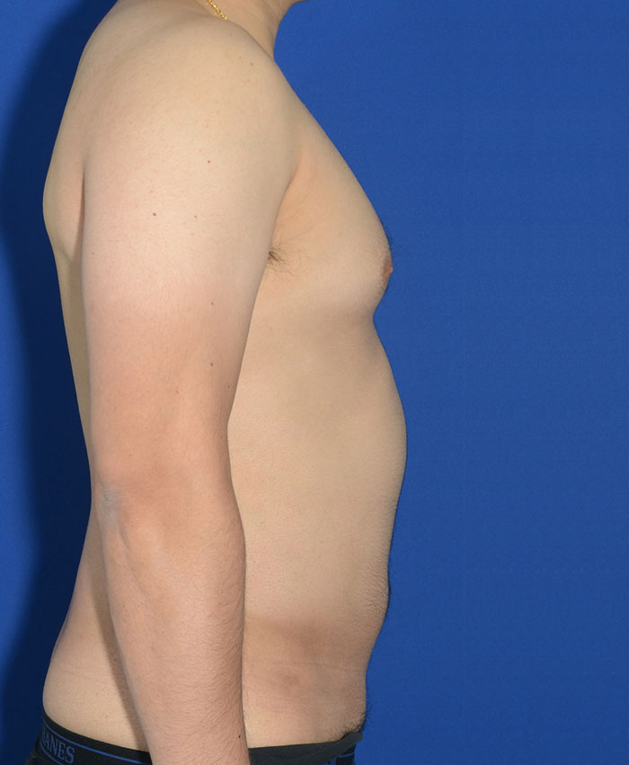 Male Plastic Surgery Before & After Photo #8