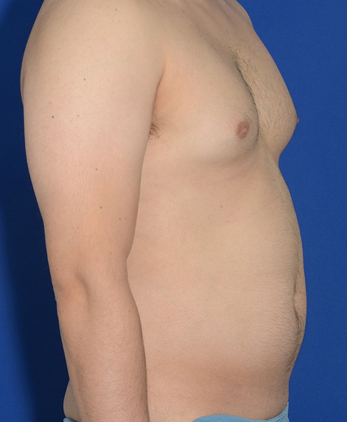 Male Plastic Surgery Before & After Photo #9
