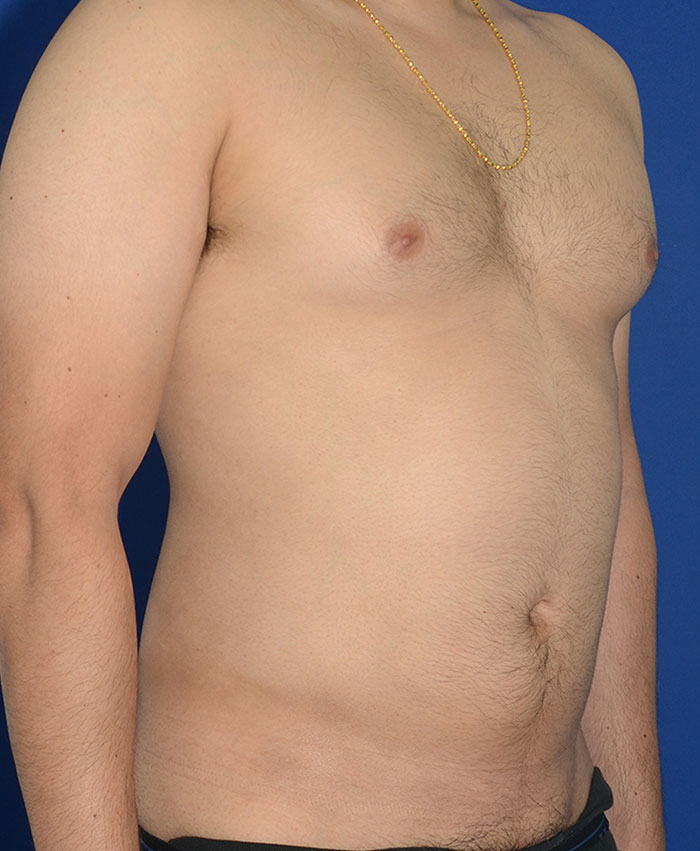 Male Plastic Surgery Before & After Photo #10