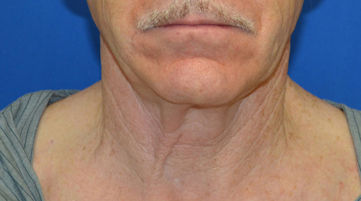 Neck Lift Before & After Photo #1