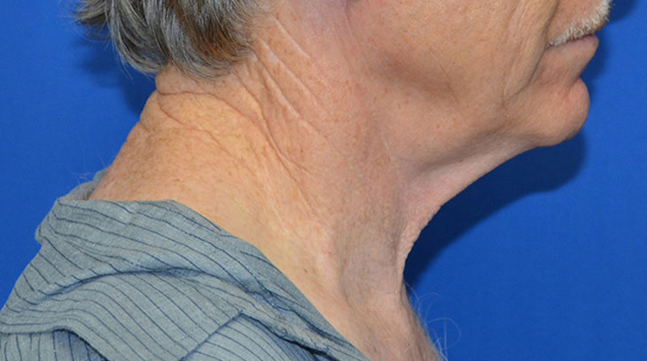 Neck Lift Before & After Photo #7