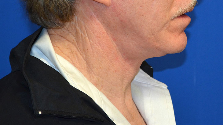 Neck Lift Before & After Photo #8