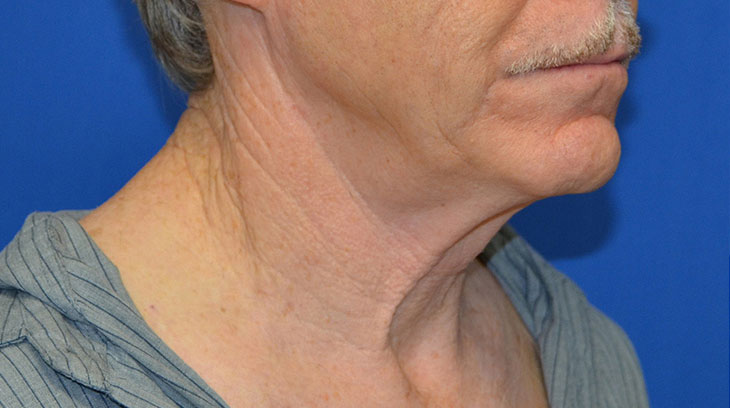 Neck Lift Before & After Photo #9