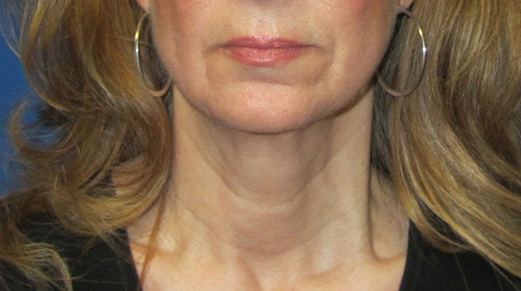 Neck Lift Before & After Photo #1