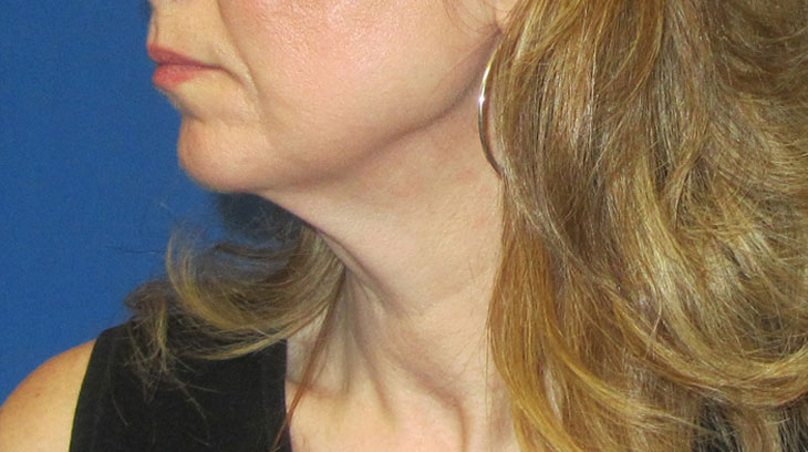 Neck Lift Before & After Photo #3