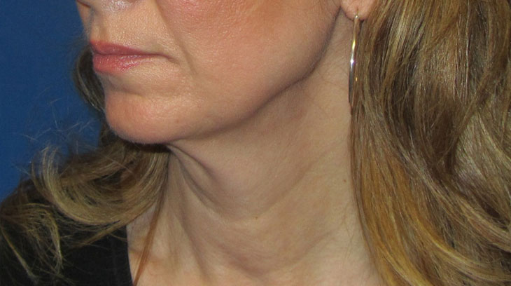 Neck Lift Before & After Photo #5
