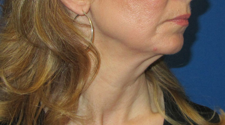 Neck Lift Before & After Photo #7