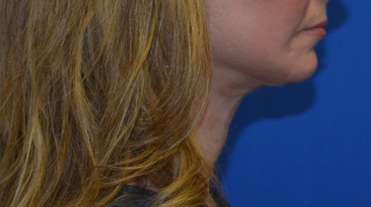 Neck Lift Before & After Photo #8